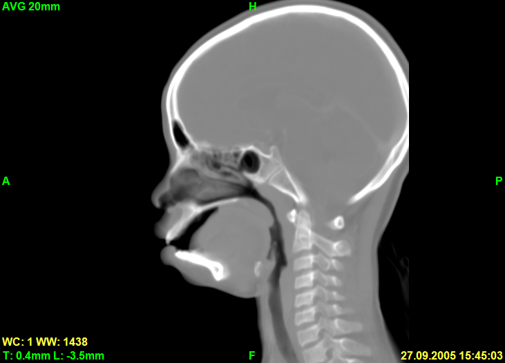 Screenshot of sagittal slice in AVG rendering mode